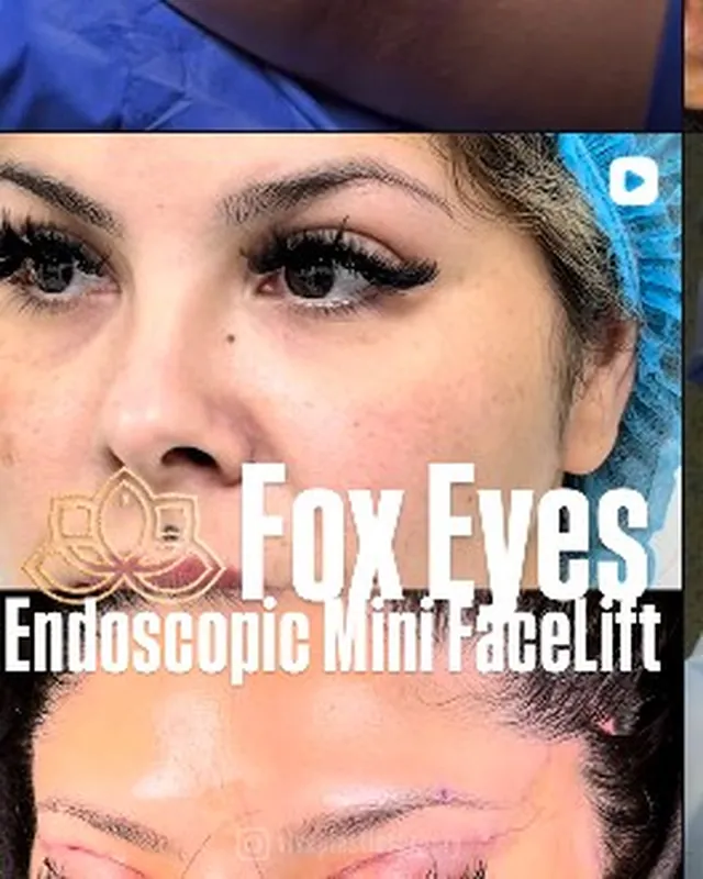 Pieza informativa sobre mini facelift endoscópico y foxy eyes