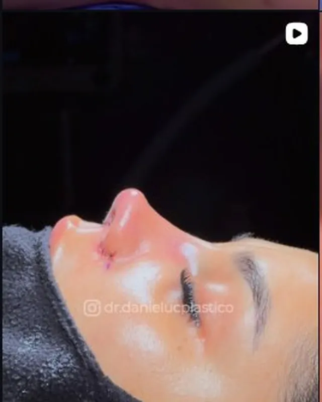 Rostro de perfil durante el postoperatorio