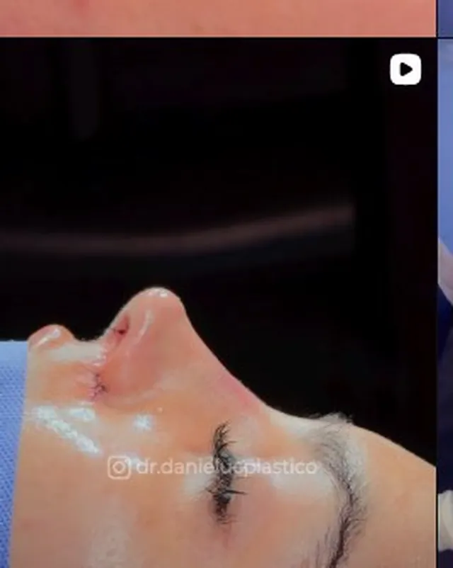 Rostro de perfil tras un procedimiento facial