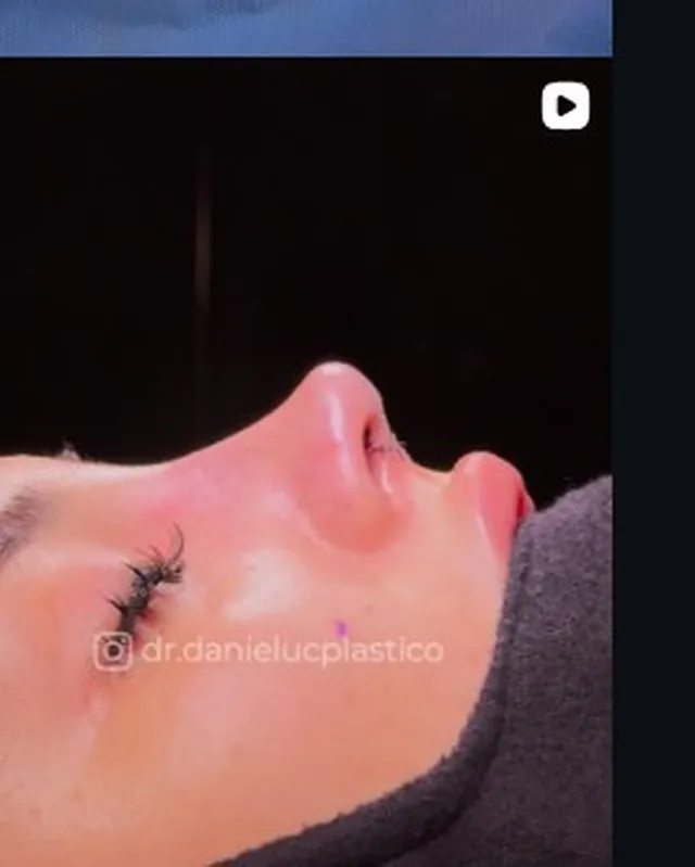 Detalle de rostro tras cirugía facial