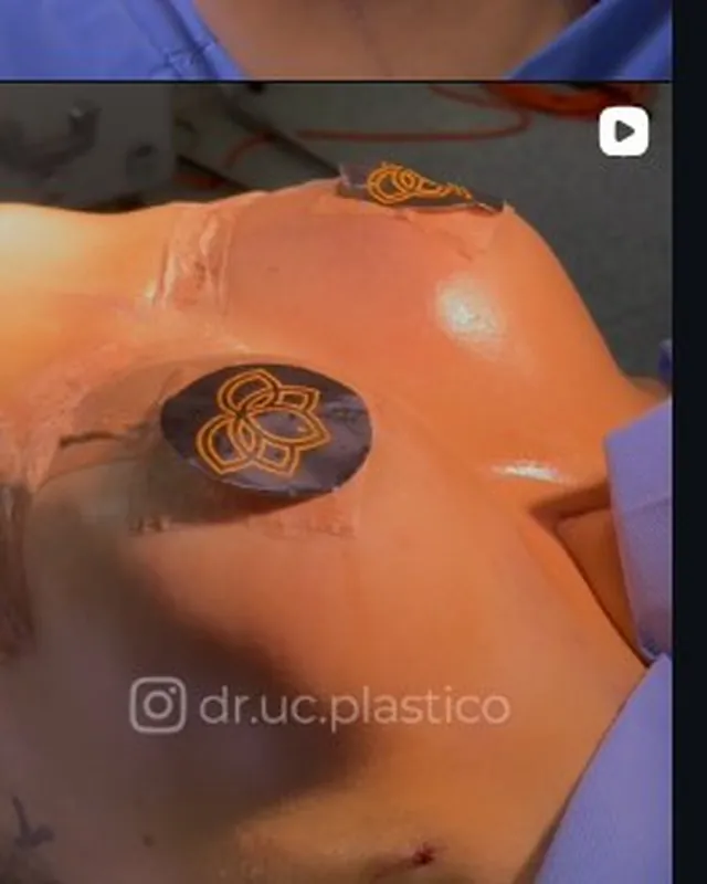 Procedimiento de contorno corporal en curso